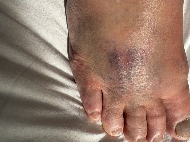 Foot day 1